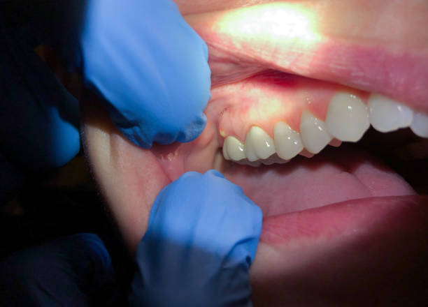 Best Emergency Tooth Extraction in Grant, NE